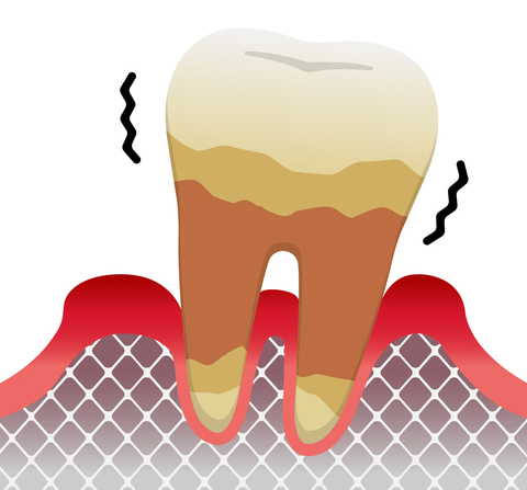 歯周病発症の進行度　重度歯周炎