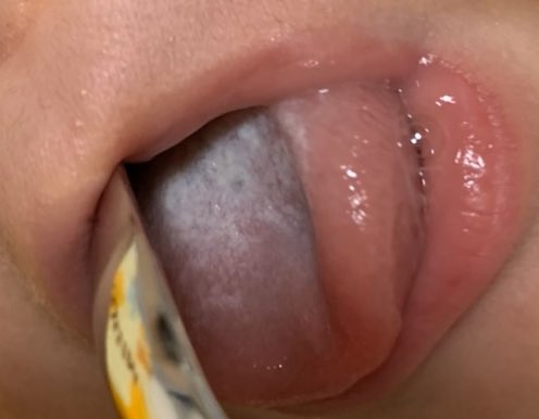 赤ちゃんの舌にカビが生えた 福岡市南区柏原の歯医者 ケンタロウ歯科