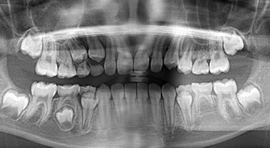乳歯がグラグラ動いてきたけど歯医者さんで抜いてもらった方がいいの 福岡市南区柏原の歯医者 ケンタロウ歯科