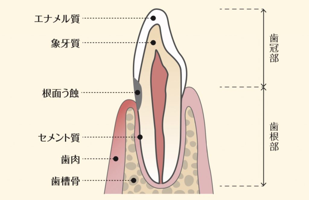 根面う蝕について | 福岡市南区の歯医者「ケンタロウ歯科・矯正