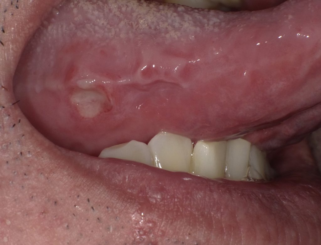 舌 の 裏 白い 口内炎