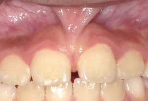 上の前歯がすきっ歯なのは上唇小帯のせい 福岡市南区の歯医者 ケンタロウ歯科