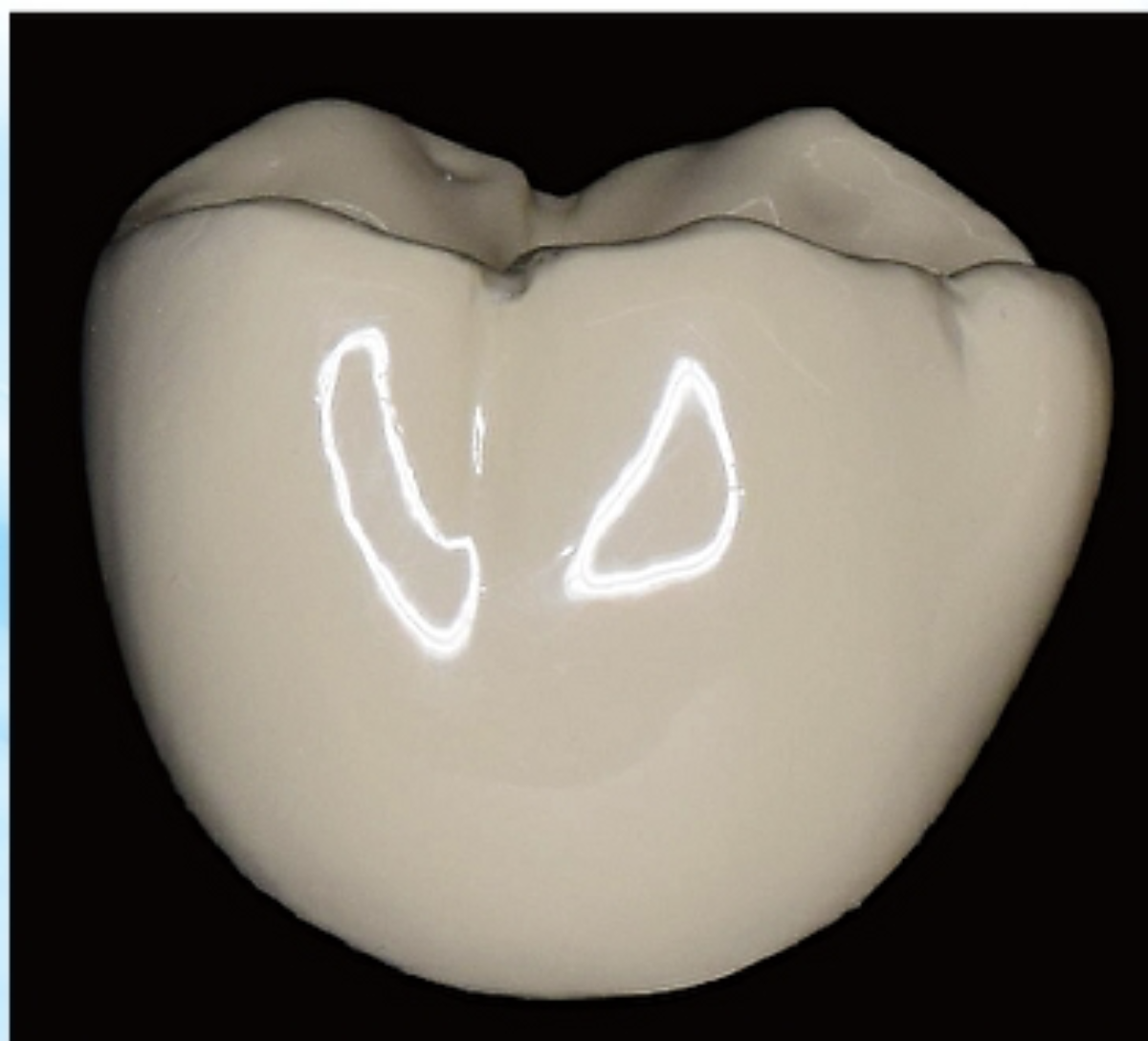 新しい保険適用の白い被せ物ご存知ですか？？ | 福岡市南区の歯医者