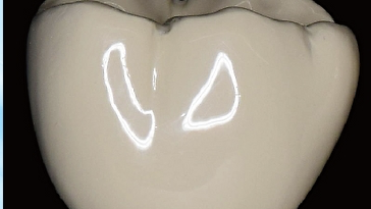 新しい保険適用の白い被せ物ご存知ですか？？ | 福岡市南区の歯医者